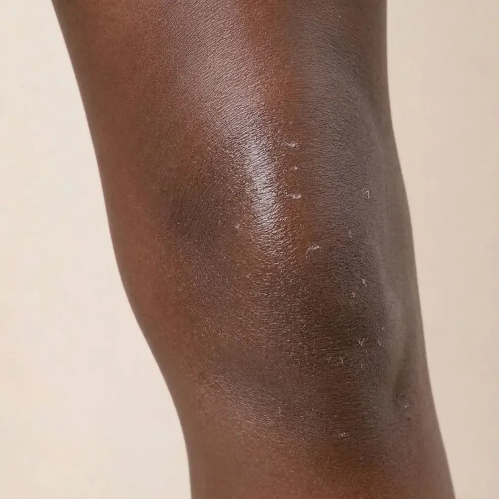 Knees, dry skin illustration