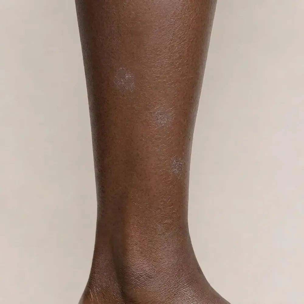 Shins & legs, dry skin illustration
